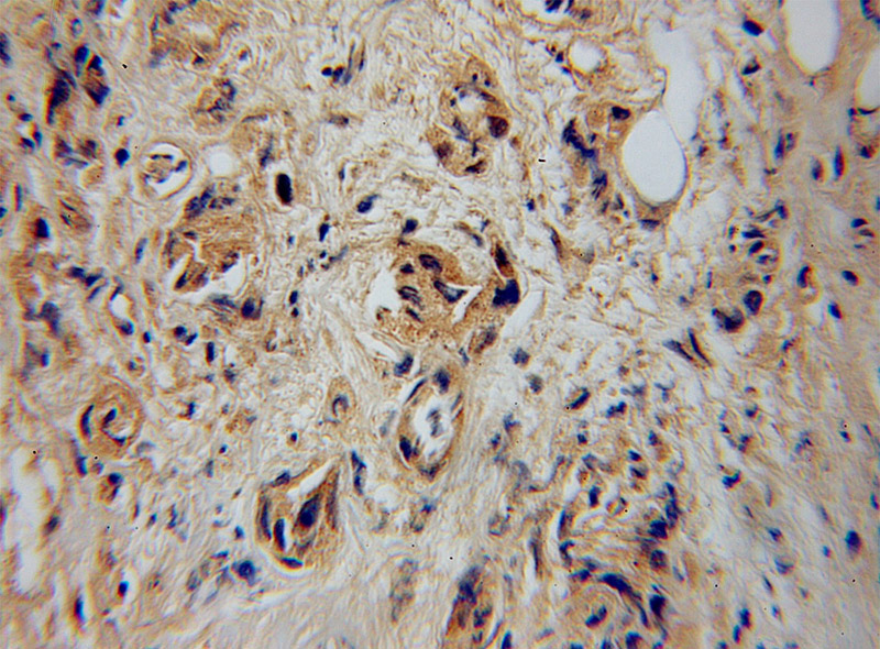 Immunohistochemical of paraffin-embedded human prostate cancer using Catalog No:112365(MACF1 antibody) at dilution of 1:100 (under 40x lens)