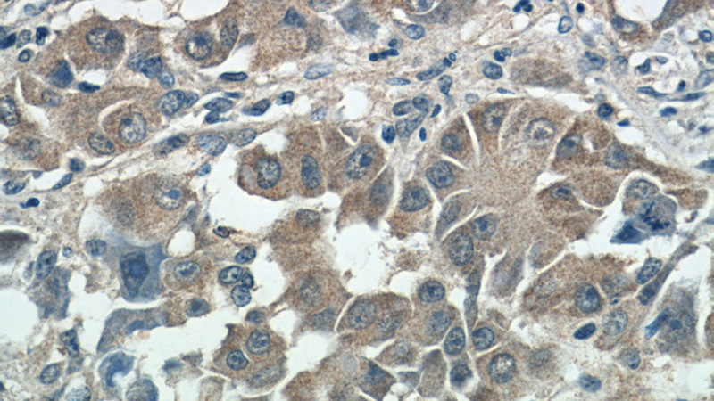 Immunohistochemistry of paraffin-embedded human liver cancer tissue slide using Catalog No:115386(SMCR7,MID49 Antibody) at dilution of 1:50 (under 40x lens)