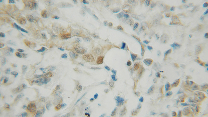 Immunohistochemical of paraffin-embedded human breast cancer using Catalog No:113765(PDCD4 antibody) at dilution of 1:50 (under 10x lens)