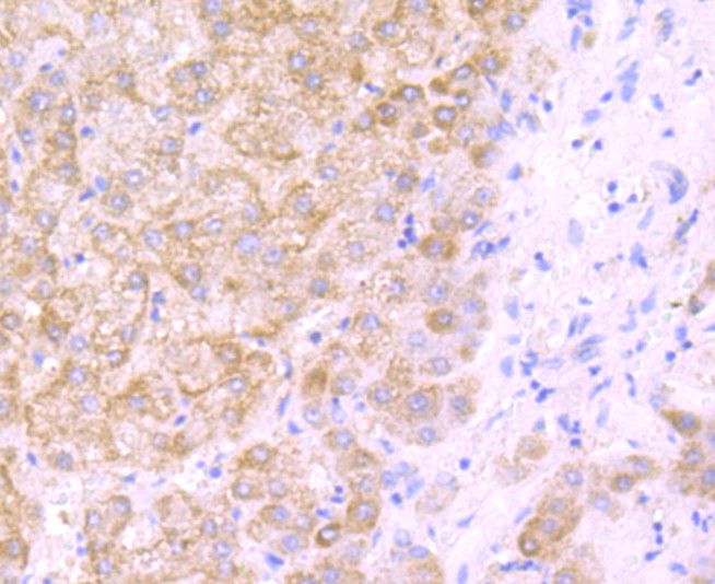 Fig5:; Immunohistochemical analysis of paraffin-embedded human liver tissue using anti-DLL4 antibody. The section was pre-treated using heat mediated antigen retrieval with Tris-EDTA buffer (pH 9.0) for 20 minutes.The tissues were blocked in 1% BSA for 30 minutes at room temperature, washed with ddH; 2; O and PBS, and then probed with the primary antibody ( 1/50) for 30 minutes at room temperature. The detection was performed using an HRP conjugated compact polymer system. DAB was used as the chromogen. Tissues were counterstained with hematoxylin and mounted with DPX.