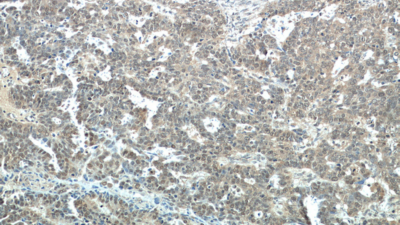 Immunohistochemical of paraffin-embedded human ovary tumor using Catalog No:112676(MLH1 antibody) at dilution of 1:50 (under 10x lens)