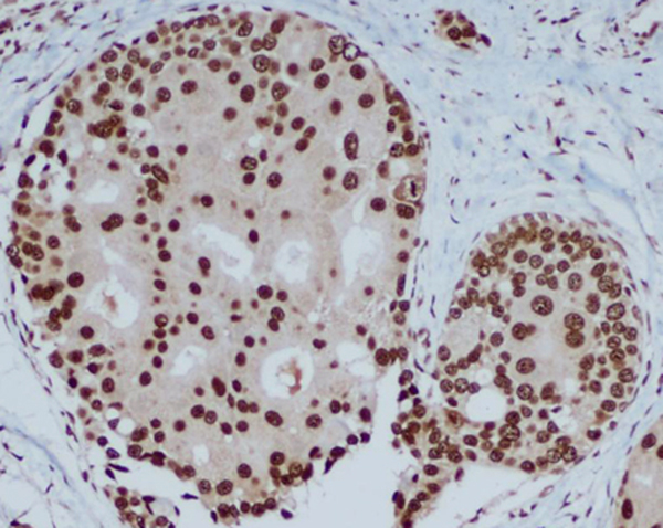 Immunohistochemical analysis of paraffin-embedded human breast carcinoma with HP1 alpha mouse mAb (3G2-H10-A6, 1:400 diluted ),showing nuclear localization.A high pressure mediated antigen retrieval step was performed in citrat buffer(pH6.0).