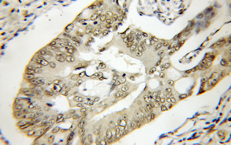 Immunohistochemical of paraffin-embedded human colon cancer using Catalog No:116376(TTC1 antibody) at dilution of 1:50 (under 10x lens)