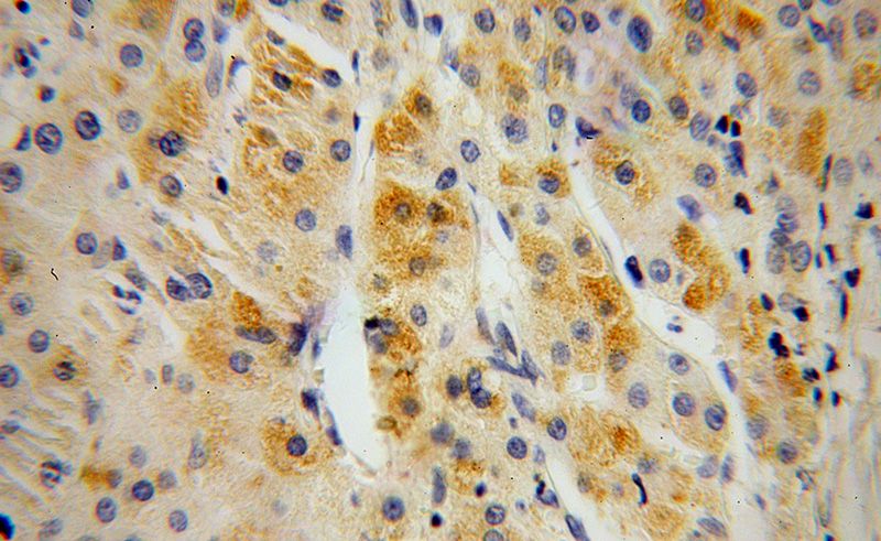Immunohistochemical of paraffin-embedded human liver cancer using Catalog No:110400(ERAP2 antibody) at dilution of 1:50 (under 40x lens)