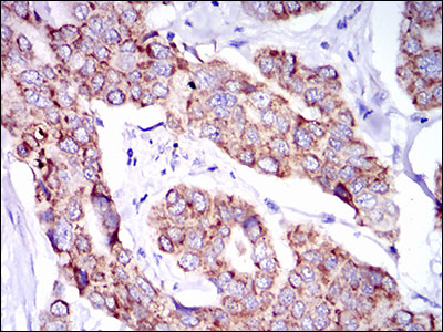 Immunohistochemical analysis of paraffin-embedded breast cancer tissues using SHP-2 mouse mAb with DAB staining.