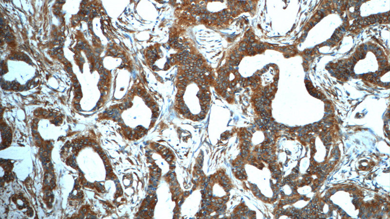 Immunohistochemistry of paraffin-embedded human breast cancer tissue slide using Catalog No:112462(SCGB2A2 Antibody) at dilution of 1:50 (under 10x lens)