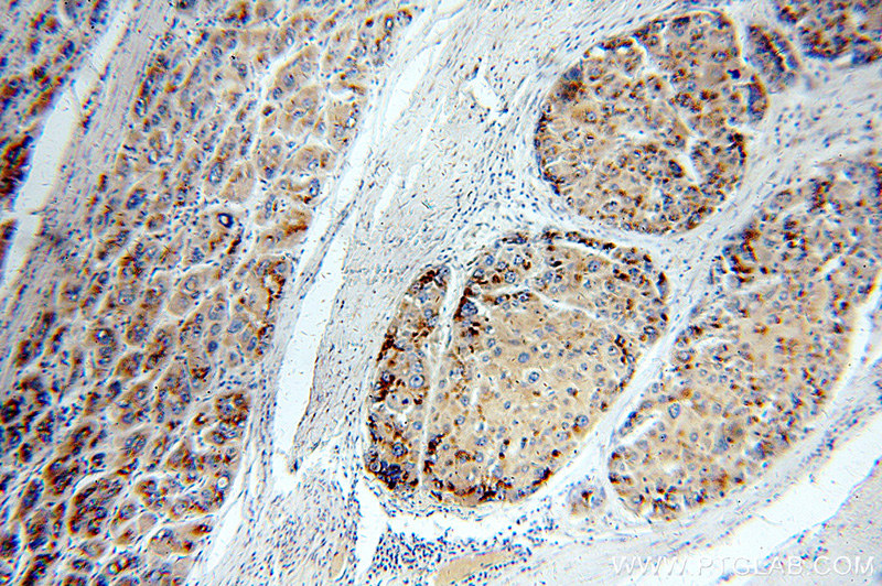 Immunohistochemical of paraffin-embedded human liver cancer using Catalog No:111054(GOLM1 antibody) at dilution of 1:100 (under 10x lens)