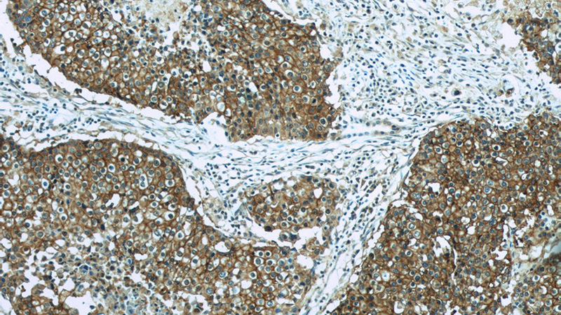 Immunohistochemistry of paraffin-embedded human lung cancer slide using Catalog No:107136(CD44 Antibody) at dilution of 1:50