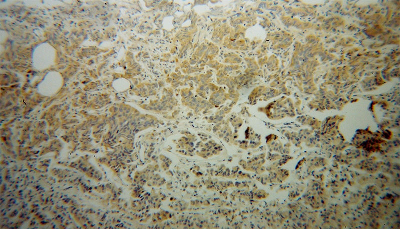 Immunohistochemical of paraffin-embedded human prostate cancer using Catalog No:113097(NEDD4L antibody) at dilution of 1:100 (under 10x lens)