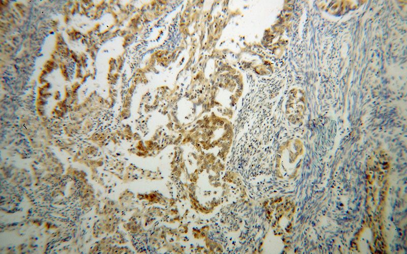Immunohistochemical of paraffin-embedded human endometrial cancer using Catalog No:112598(MGEA5 antibody) at dilution of 1:100 (under 10x lens)
