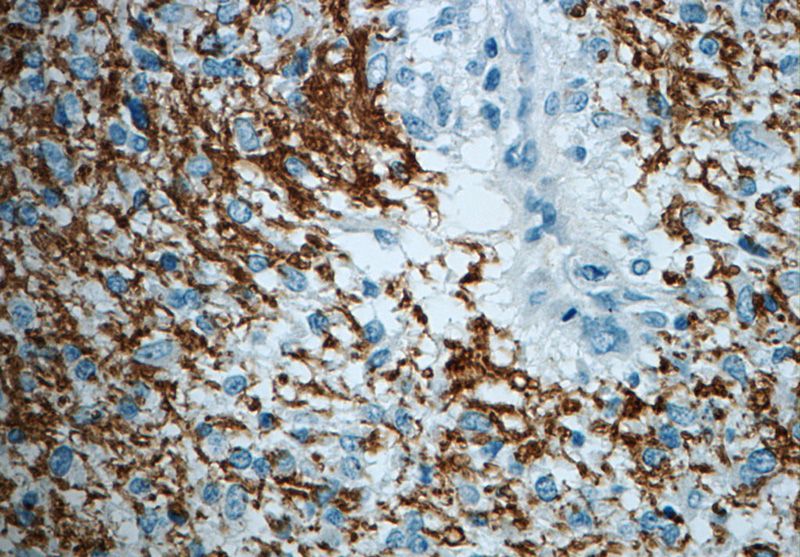 Immunohistochemistry of paraffin-embedded human gliomas slide using Catalog No:114775(ROBO3-Specific Antibody) at dilution of 1:50