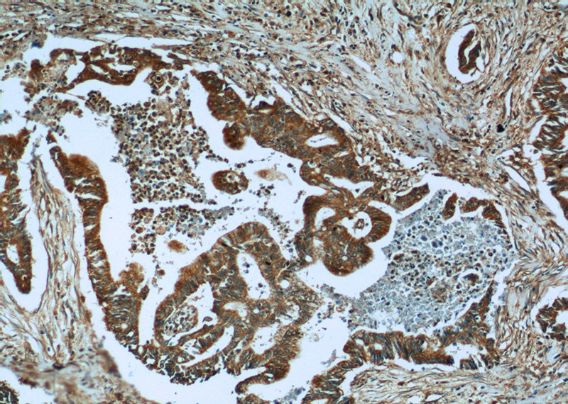 Immunohistochemistry of paraffin-embedded human pancreas cancer tissue slide using Catalog No:116260(PLAT Antibody) at dilution of 1:50 (under 10x lens)