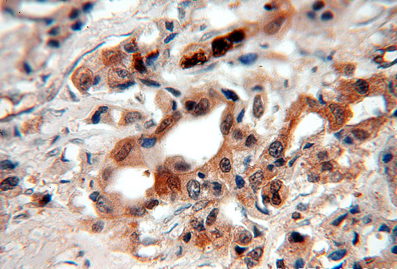 Immunohistochemical of paraffin-embedded human breast cancer using Catalog No:114966(S100A9 antibody) at dilution of 1:100 (under 40x lens)
