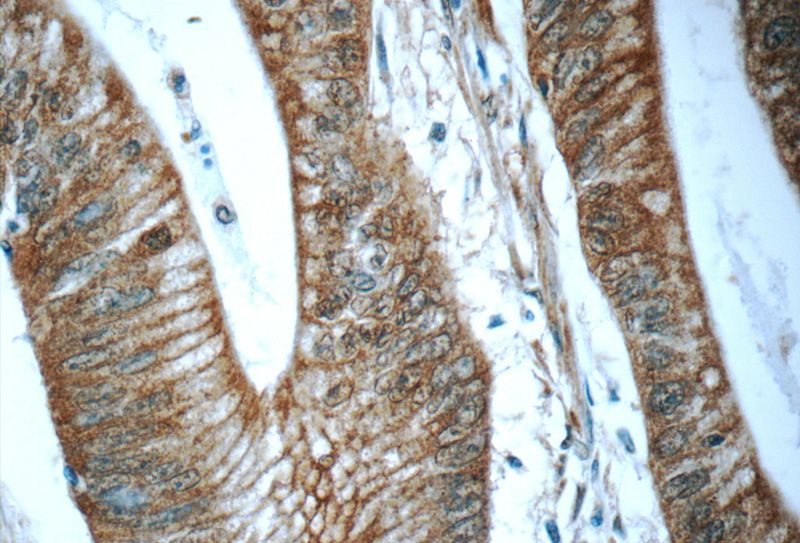 Immunohistochemistry of paraffin-embedded human colon cancer tissue slide using Catalog No:117117(BEND4 Antibody) at dilution of 1:50 (under 40x lens)
