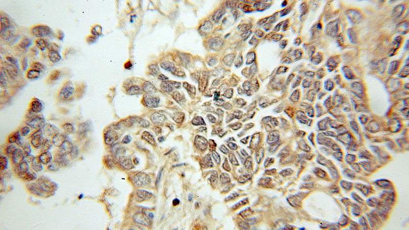 Immunohistochemical of paraffin-embedded human pancreas cancer using Catalog No:113411(NUDC antibody) at dilution of 1:50 (under 10x lens)