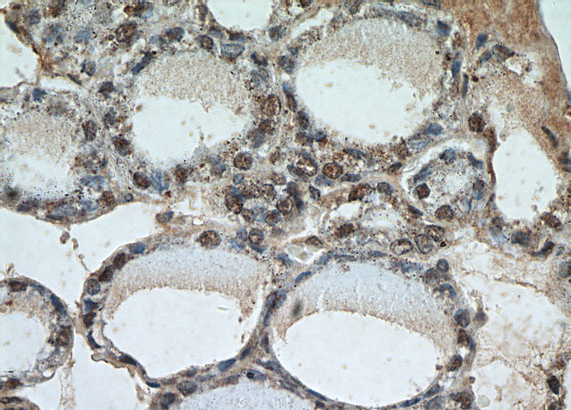 Immunohistochemical of paraffin-embedded human thyroid using Catalog No:107455(PAX8-Specific antibody) at dilution of 1:50 (under 40x lens)