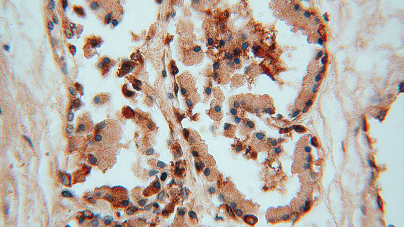 Immunohistochemical of paraffin-embedded human prostate using Catalog No:111369(hD53; TPD52L1 antibody) at dilution of 1:50 (under 40x lens)