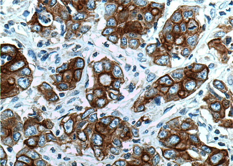 Immunohistochemistry of paraffin-embedded human stomach cancer tissue slide using Catalog No:107232(KRT19 Antibody) at dilution of 1:200 (under 40x lens). heat mediated antigen retrieved with Tris-EDTA buffer(pH9).