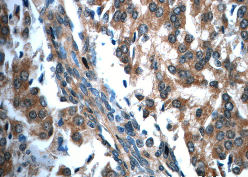 Immunohistochemistry of paraffin-embedded human prostate cancer slide using Catalog No:116607(USP33 Antibody) at dilution of 1:50(under 40x lens)