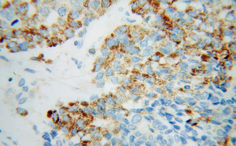 Immunohistochemical of paraffin-embedded human liver cancer using Catalog No:113647(PECR antibody) at dilution of 1:100 (under 40x lens)