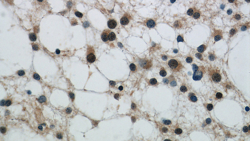 Immunohistochemical of paraffin-embedded human gliomas using Catalog No:113557(SQSTM1 antibody) at dilution of 1:50 (under 40x lens)