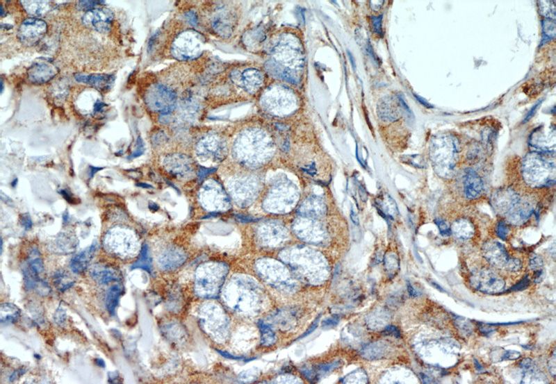 Immunohistochemistry of paraffin-embedded human breast cancer slide using Catalog No:109799(KRT18 Antibody) at dilution of 1:50