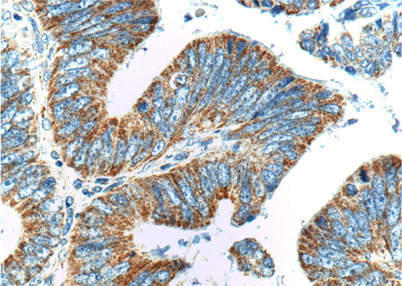 Immunohistochemistry of paraffin-embedded human colon cancer tissue slide using Catalog No:115385(C11orf75 Antibody) at dilution of 1:200 (under 40x lens).