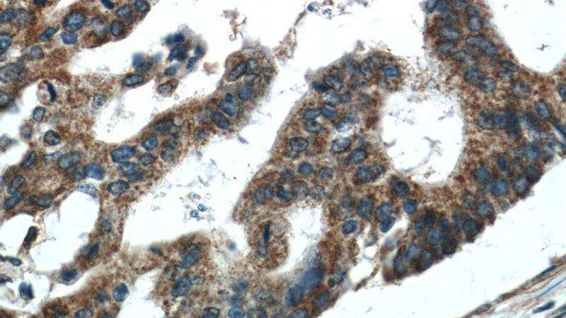 Immunohistochemistry of paraffin-embedded human pancreas cancer tissue slide using Catalog No:116085(TMED2 Antibody) at dilution of 1:50 (under 40x lens)