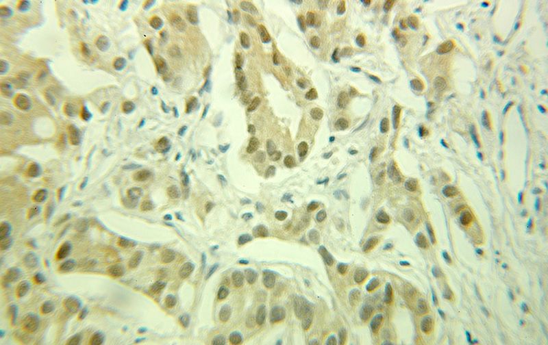 Immunohistochemical of paraffin-embedded human prostate cancer using Catalog No:110676(FKBP52 antibody) at dilution of 1:100 (under 25x lens)