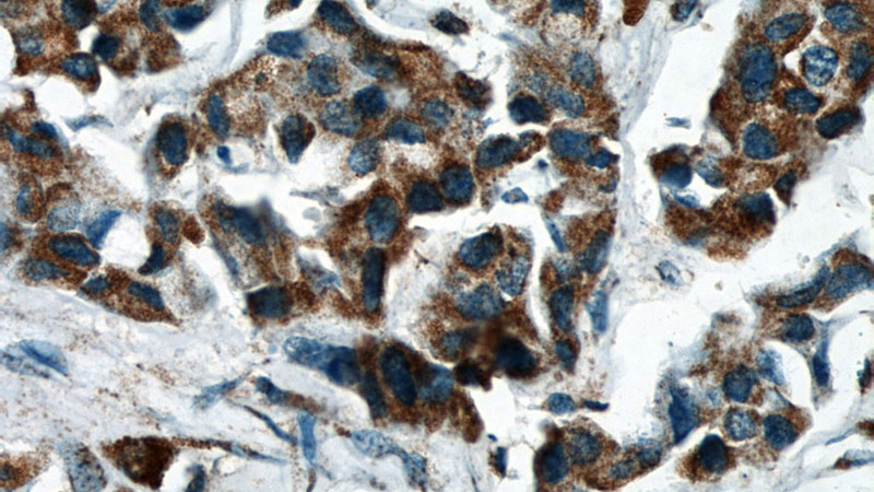 Immunohistochemical of paraffin-embedded human breast cancer using Catalog No:114101(PPP2R2C antibody) at dilution of 1:50 (under 40x lens)