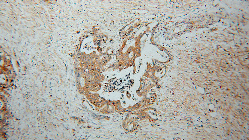 Immunohistochemical of paraffin-embedded human stomach cancer using Catalog No:108308(ATP6V1C1 antibody) at dilution of 1:50 (under 10x lens)