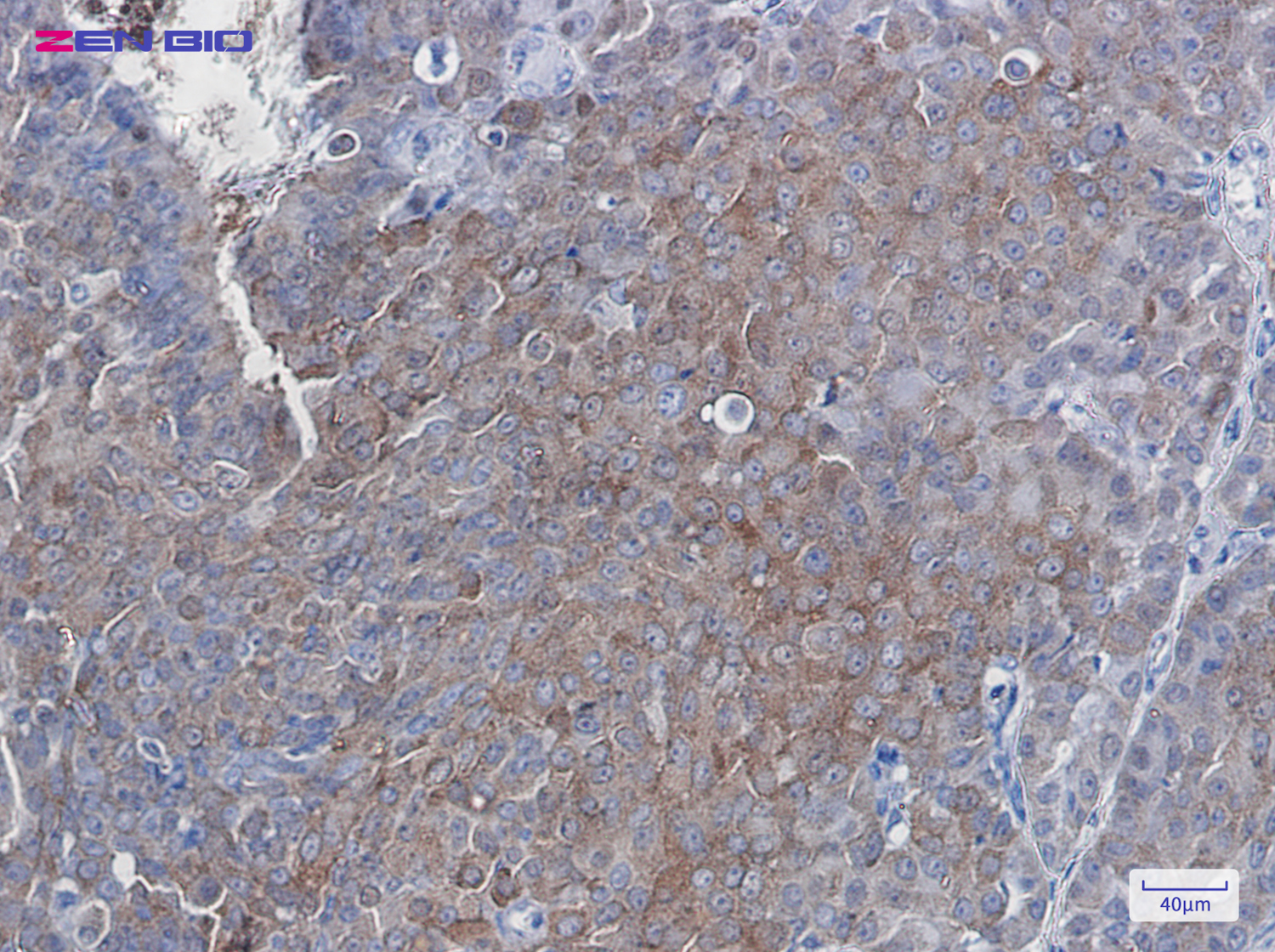Immunohistochemistry of SQSTM1 in paraffin-embedded Human breast cancer tissue using SQSTM1 Rabbit pAb at dilution 1/50