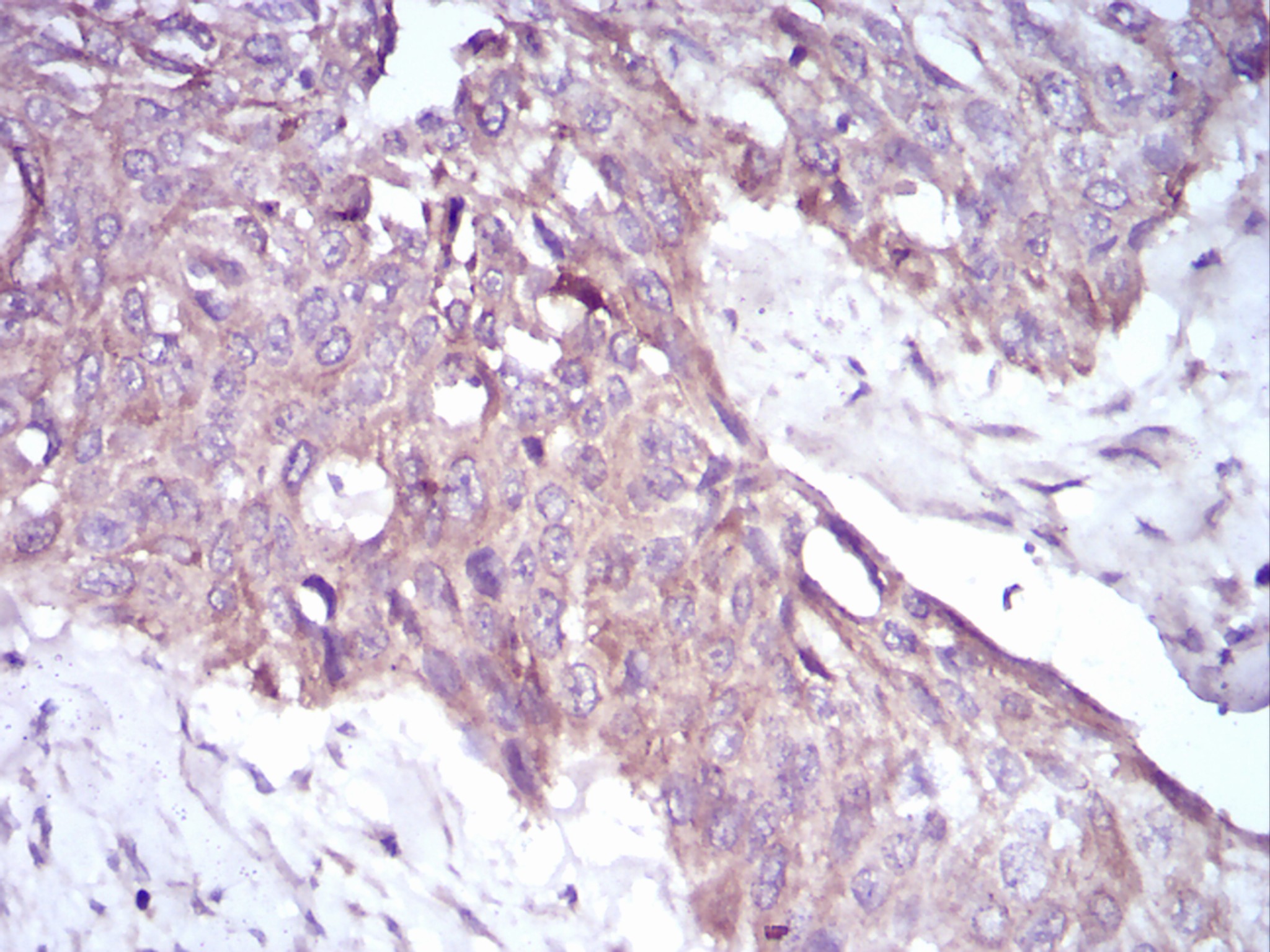 Fig3: Immunohistochemical analysis of paraffin-embedded human esophageal cancer tissue using anti-PKHD1 antibody. Counter stained with hematoxylin.