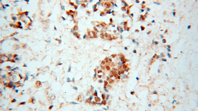 Immunohistochemical of paraffin-embedded human breast cancer using Catalog No:114208(PRMT6 antibody) at dilution of 1:100 (under 40x lens)