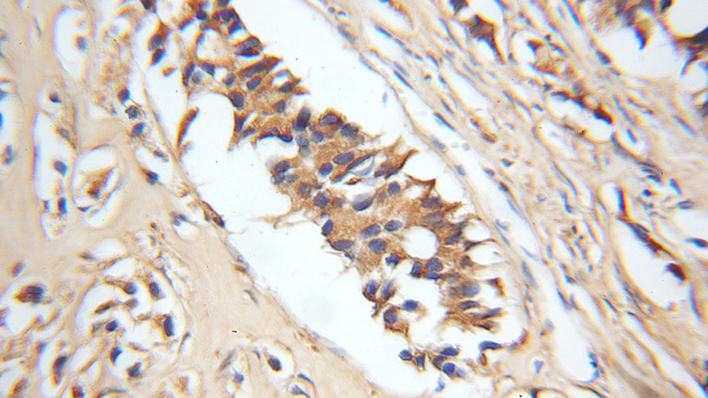 Immunohistochemical of paraffin-embedded human prostate cancer using Catalog No:110357(ERGIC2 antibody) at dilution of 1:50 (under 10x lens)