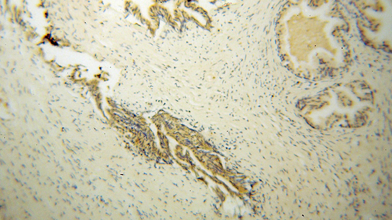 Immunohistochemical of paraffin-embedded human gliomas using Catalog No:115083(SEC6 antibody) at dilution of 1:100 (under 10x lens)