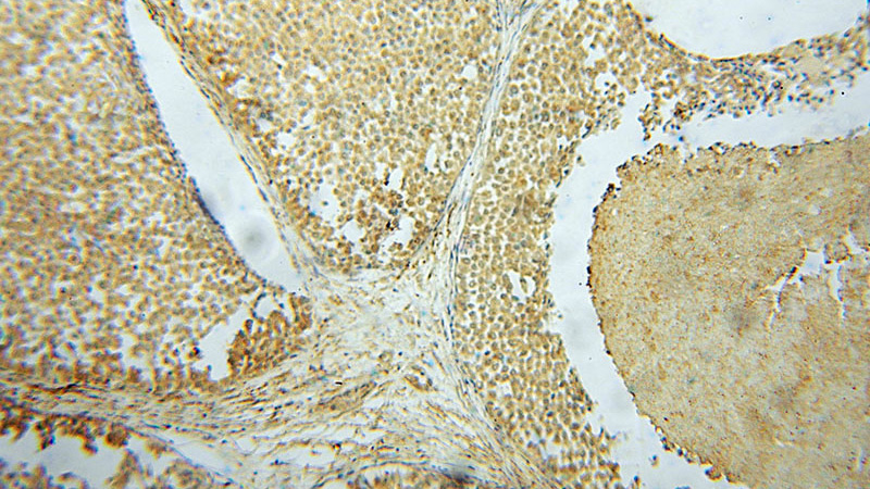 Immunohistochemical of paraffin-embedded human breast cancer using Catalog No:112371(MAEA antibody) at dilution of 1:50 (under 10x lens)