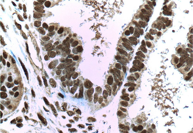 Immunohistochemistry of paraffin-embedded human ovary tumor tissue slide using Catalog No:107194(ERK1/2 Antibody) at dilution of 1:200 (under 40x lens). Heat mediated antigen retrieved with Tris-EDTA buffer, pH9.0