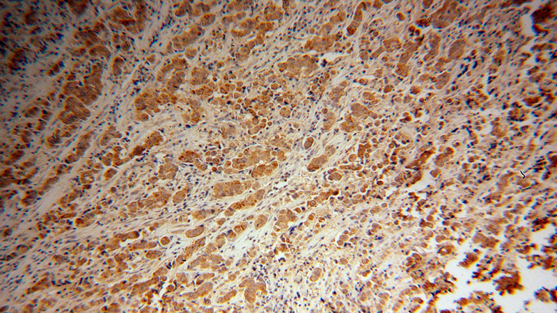 Immunohistochemical of paraffin-embedded human prostate cancer using Catalog No:111075(GLUD2 antibody) at dilution of 1:100 (under 10x lens)