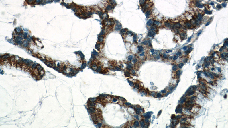 Immunohistochemistry of paraffin-embedded human colon cancer tissue slide using Catalog No:108614(C18orf21 Antibody) at dilution of 1:50 (under 40x lens)