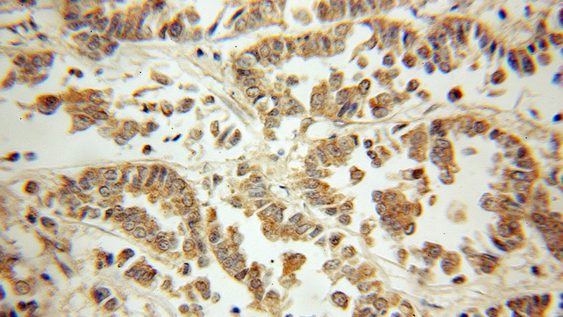 Immunohistochemical of paraffin-embedded human breast cancer using Catalog No:117063(ZIPK-Phospho 311Ser antibody) at dilution of 1:50 (under 10x lens)