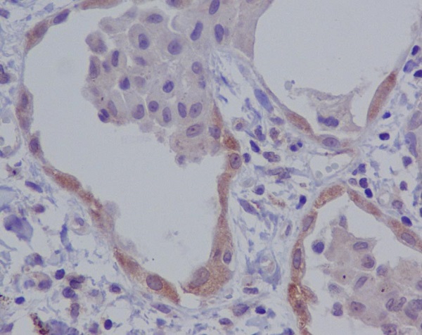 Immunohistochemical analysis of paraffin-embedded human lung carcinoma, using NALP3 Antibody.