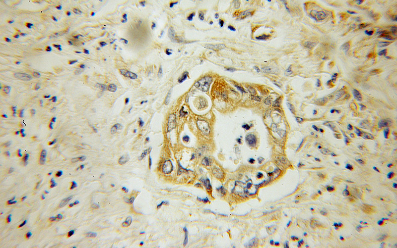 Immunohistochemical of paraffin-embedded human pancreas cancer using Catalog No:110102(DNAJC10 antibody) at dilution of 1:100 (under 10x lens)