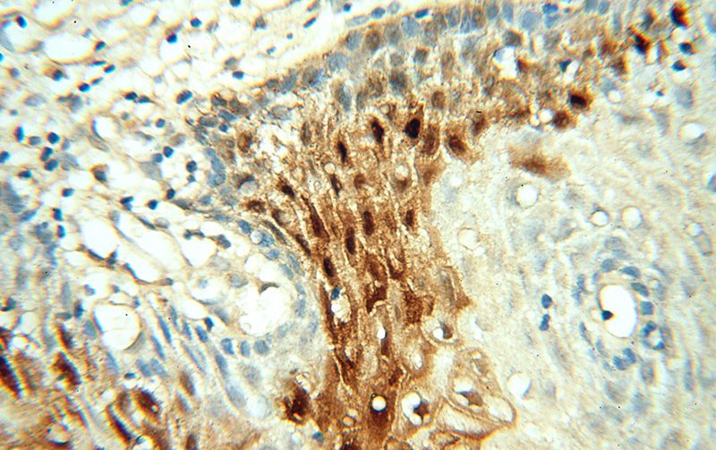 Immunohistochemical of paraffin-embedded human cervix using Catalog No:110439(FABP4 antibody) at dilution of 1:50 (under 40x lens)
