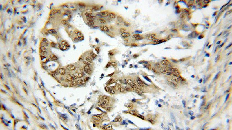 Immunohistochemical of paraffin-embedded human colon cancer using Catalog No:116235(TRAF7 antibody) at dilution of 1:50 (under 10x lens)