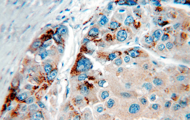 Immunohistochemical of paraffin-embedded human liver cancer using Catalog No:111054(GOLM1 antibody) at dilution of 1:100 (under 40x lens)