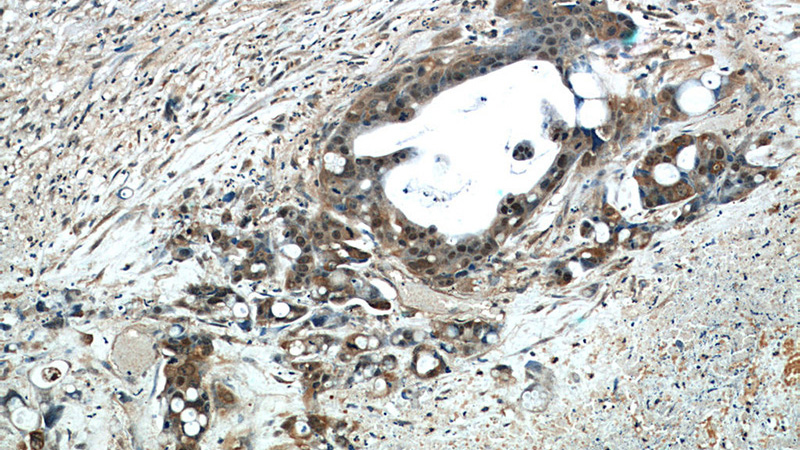 Immunohistochemical of paraffin-embedded human liver cancer using Catalog No:110958(GGCT antibody) at dilution of 1:50 (under 10x lens)