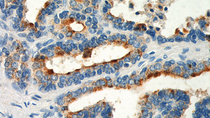 Immunohistochemistry of paraffin-embedded human prostate hyperplasia tissue slide using Catalog No:111131(GPR55 Antibody) at dilution of 1:200 (under 40x lens).