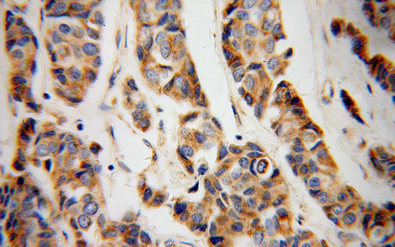 Immunohistochemical of paraffin-embedded human breast cancer using Catalog No:109659(CYC1 antibody) at dilution of 1:100 (under 40x lens)