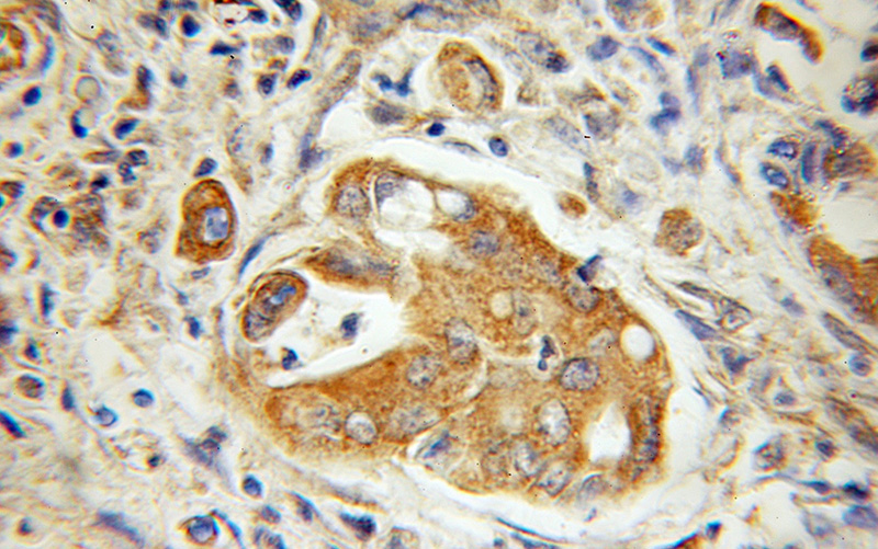 Immunohistochemical of paraffin-embedded human colon cancer using Catalog No:111755(ILVBL antibody) at dilution of 1:100 (under 10x lens)